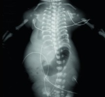 <ol><li><p>What is abnormal about this image?</p></li><li><p>This finding can be associated with what pathology?</p></li></ol><p></p>