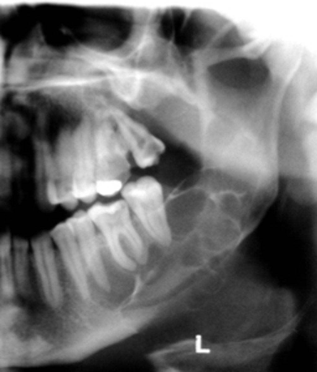 <p>ID the cyst:</p><p>•Well defined corticated periphery</p><p>•Undulating/scalloped borders</p><p>•Radiolucent interior</p><p>•Multilocularity (internal septae) is typically noted, but may be unilocular</p><p>•Minimal expansion and thinning of cortices</p><p>•Displacement of IAN canal inferiorly</p><p>•Displacement and resorption of teeth may be seen</p>