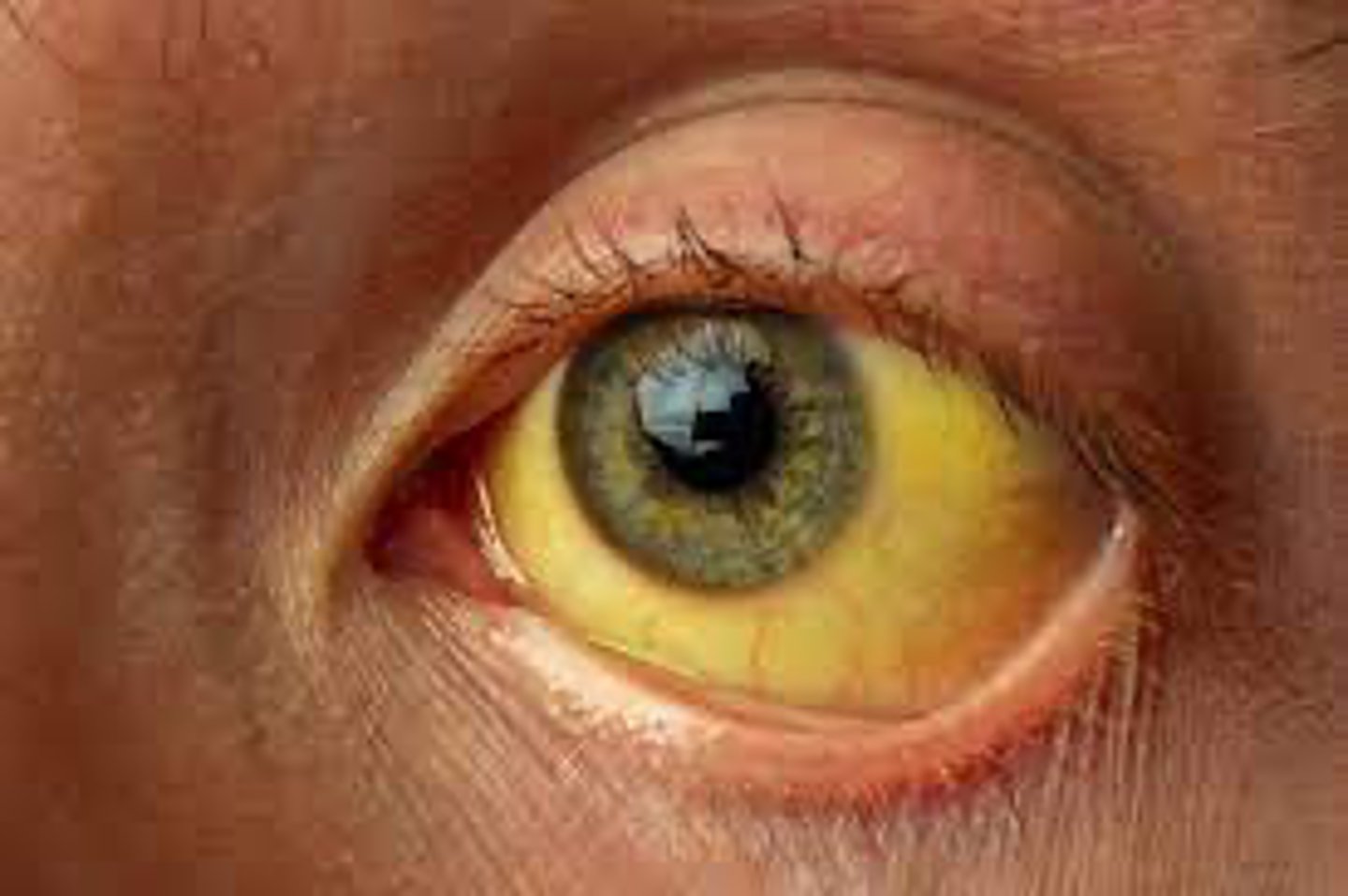 <p>s/s =</p><p>- abdominal pain</p><p>- ascites</p><p>- N/V</p><p>- jaundice</p><p>- pain w/ eating</p><p>- fever/confusion can occur as well</p>