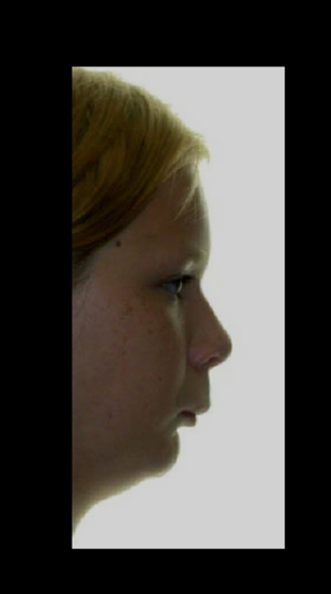 <p>overbite</p>