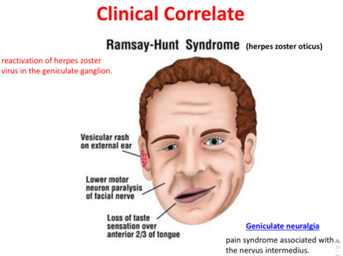 <p>Manifestation of herpes zoster infection in the ear</p><p>- facial nerve palsy and vesicles in the auditory canal and auricle</p>