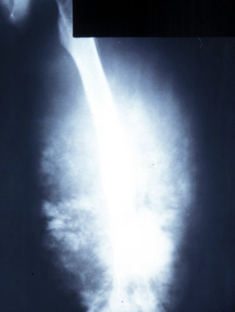 <p>Radiographic Features of Osteosarcoma</p>