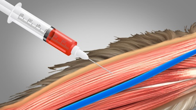 <p>What type of injection is shown in the image below?</p><p>A. Intradermic</p><p>B. Subcutaneous</p><p>C. Intravenous</p><p>D. Intramuscular</p>