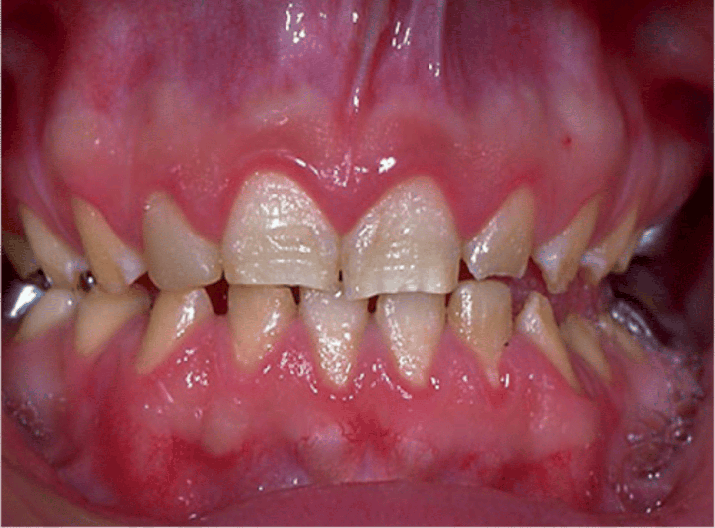 <p>- Enamel missing due to disturbances of ameloblasts<br>- Yellowish-brown or gray-brown appearance</p>
