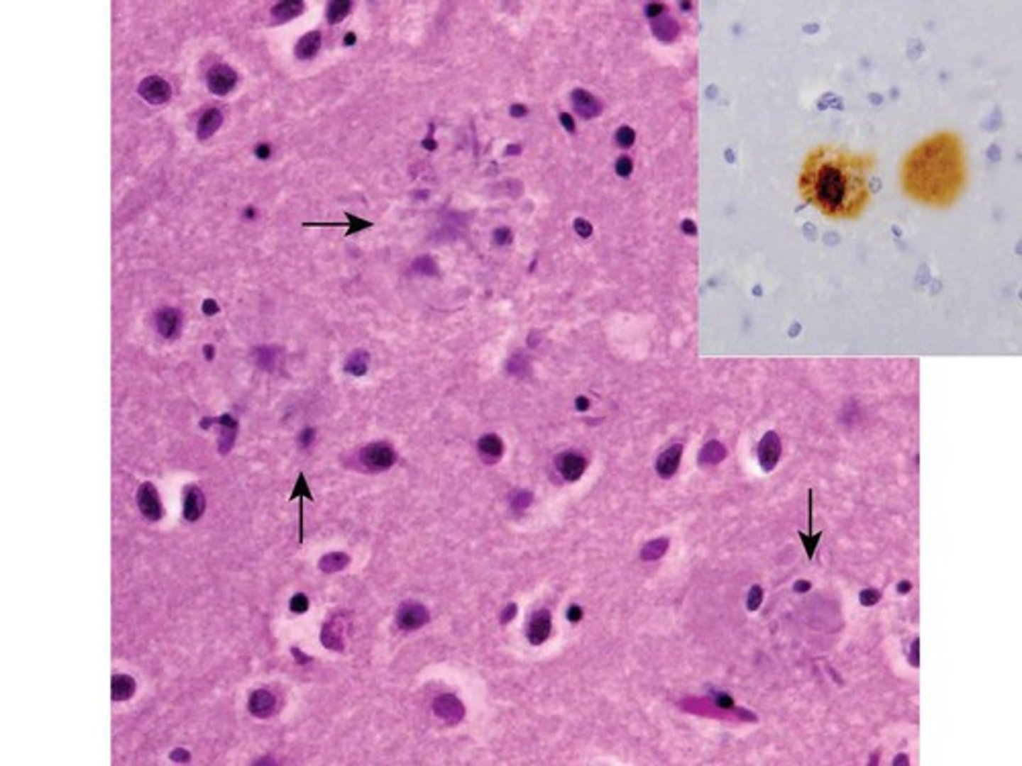 <p>fragments of the protein beta-amyloid that accumulate into insoluble plaques that inhibit communication between neurons</p>