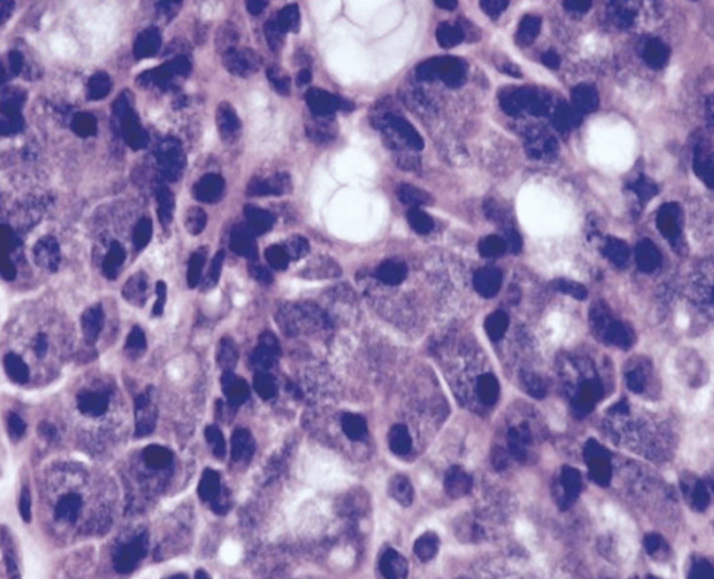 <p>These histologic characteristics are indicative of what oral pathology?</p><p>Well circumscribed</p><p>May show infiltration</p><p>Serous acinar cells ---(cells containing abundant granular cytoplasm</p><p>Zymogen granules )</p>