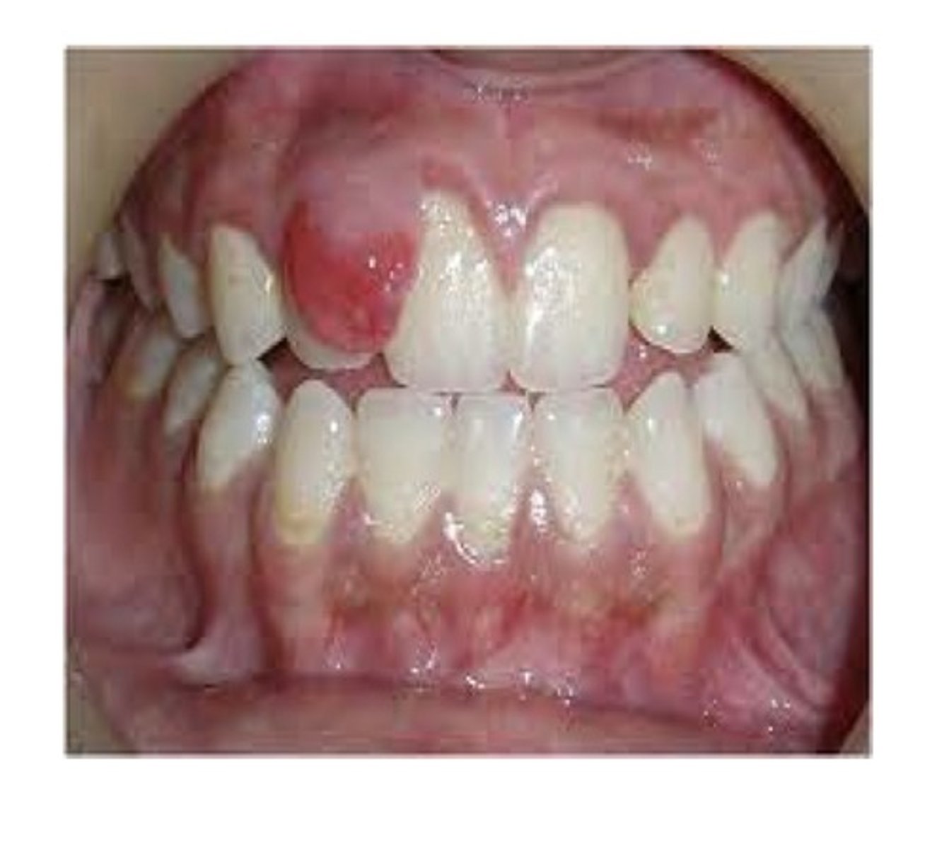 <p>A well demarcated sessile or pedunculated lesion, most likely derived from cells of the periodontal ligament. More common in females. Often occurs in young people. Related to hormones and bacterial influence like calculus. Composed of cellular fibrous connective tissue interspersed with scattered bone and cementum-like calcifications. Looks like a pyogenic granuloma (pregnancy tumour)but is different bc it's calcifying.</p>