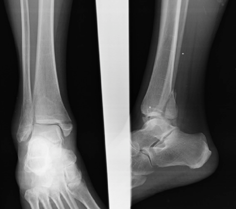 <p>What kind of fracture is shown?</p>