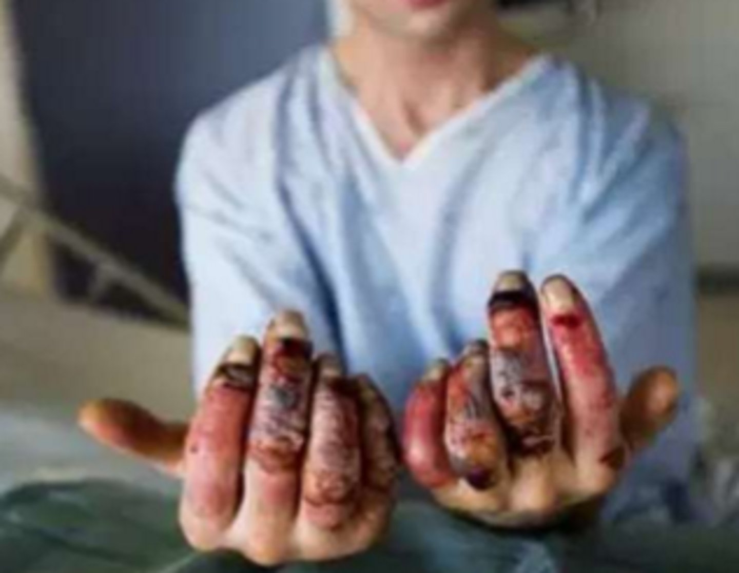 <p>- normal cutaneous flow: 200 mL/min</p><p>- skin temp at 15 degrees: 20 mL/min (flow drops x10)</p>