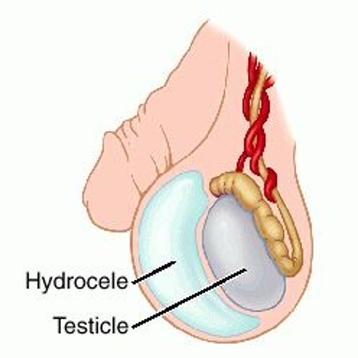 <p>-may be painful, with erythema and tenderness</p><p>-chronic hydroceles are typically painless</p><p>-sensation of heaviness</p><p>-transilluminates</p><p>-diffuse scrotal swelling</p><p>-not usually reducible</p><p>-may have generalized bluish discoloration</p><p>-preserved cremasteric reflex</p>