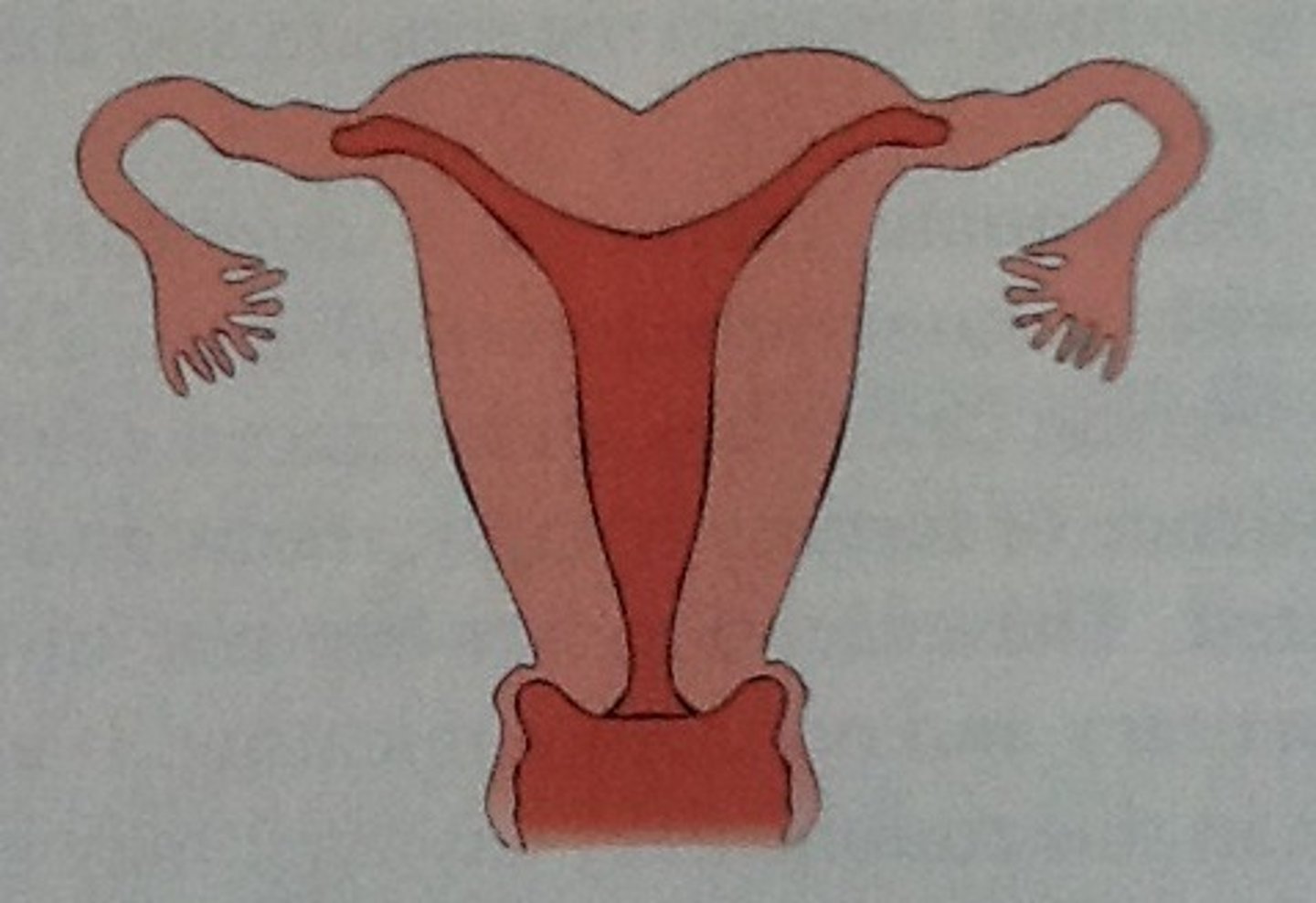 <p>Uterus with a dent on the top part</p>