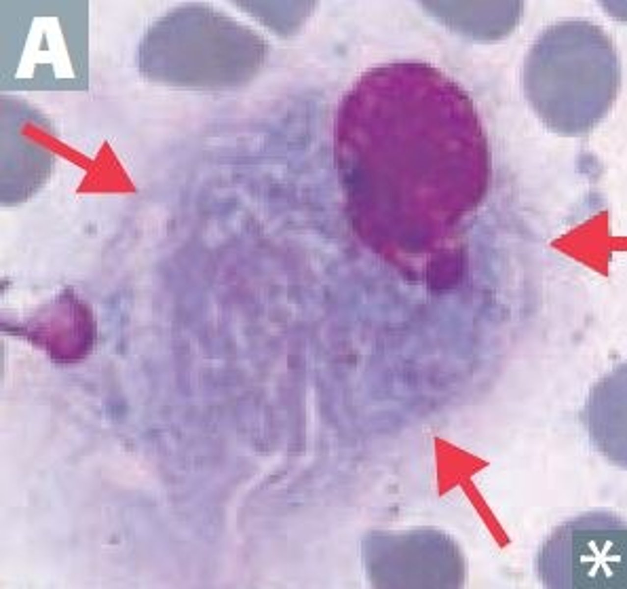 <p>glucocerebrosidase def. = ↑ glucocerebroside</p><p>- crumpled tissue paper look</p><p>- hepatosplenomegaly</p>