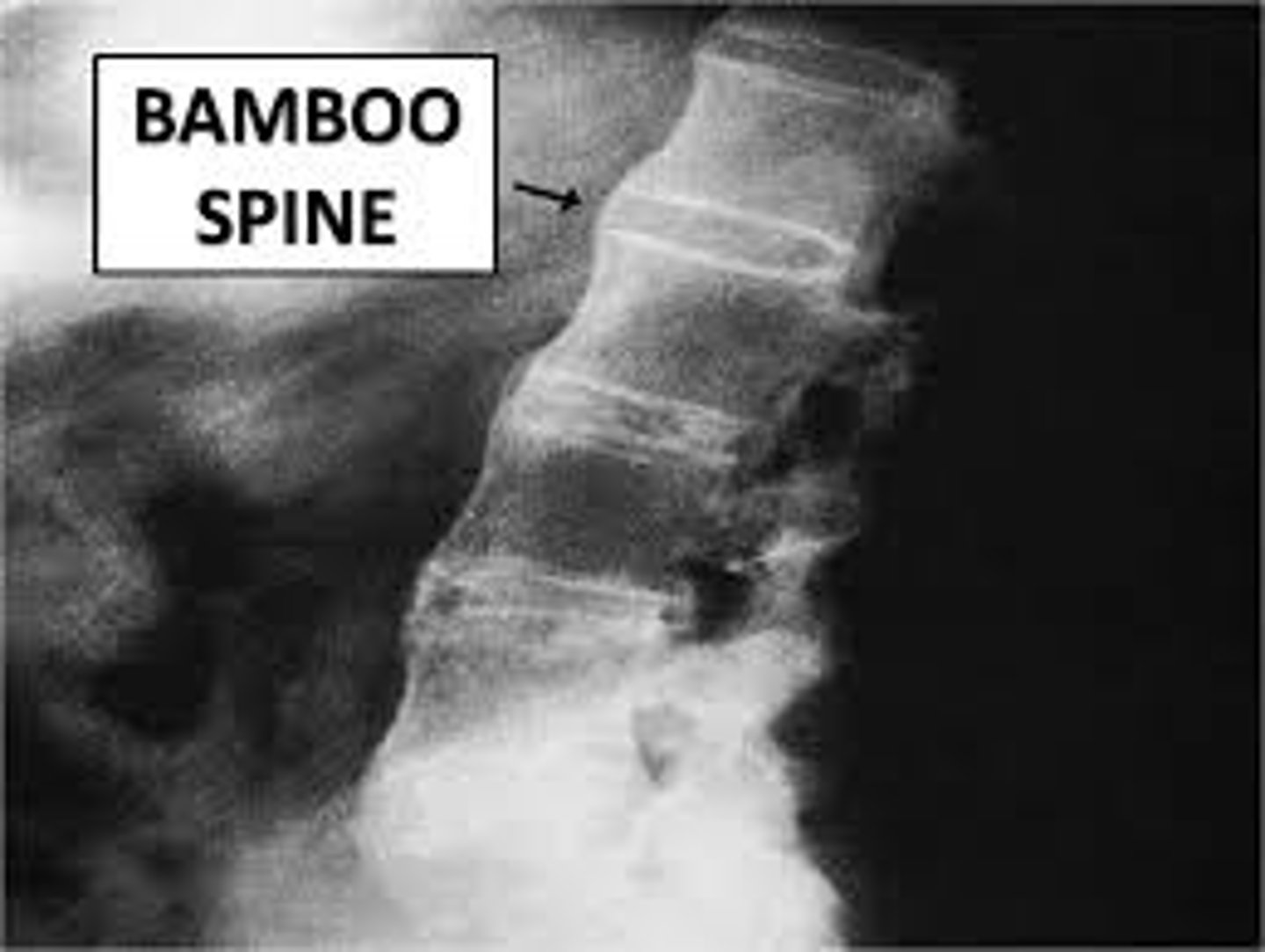 <p>Inflammation of the axial skeleton associated w/ +HLA-B27 </p><p>Low back pain w/ decreased mobility Symmetrical inflammation of SI joints, gradual onset, relieved by exercise and worse w/ rest </p><p>Bamboo spine on imaging </p>