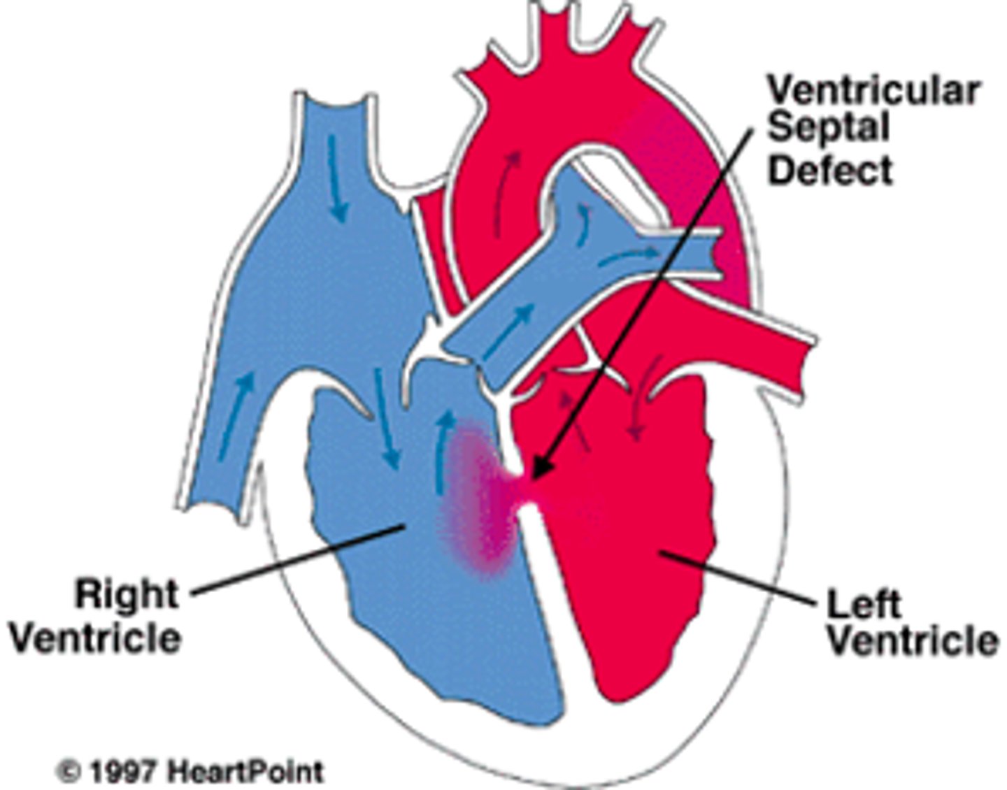 <p>hole in septum between ventricles --> many close early in life</p>