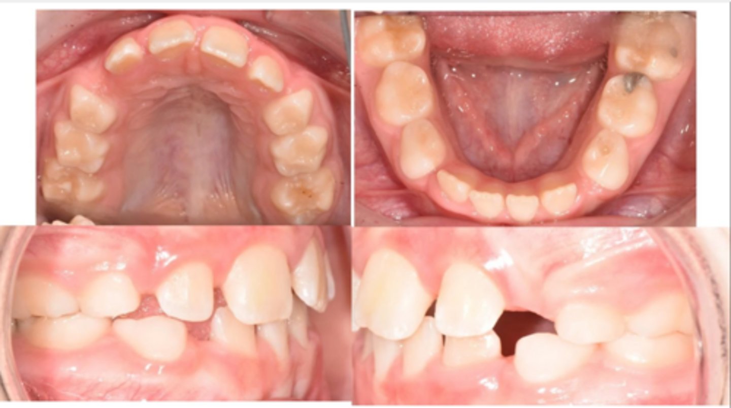 <p>The patient does not have congenitally missing teeth and has 9 mm of crowding. He has Class I molar relation. What is the tx?</p>