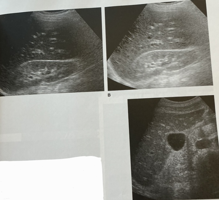 <p>What is this sign? In what disease does this happen?</p>