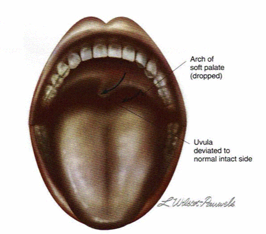 <ul><li><p>difficulty swallowing</p><ul><li><p>inability to elevate soft palate on affected side; paralysis of levator palatini muscle; pharyngeal muscles </p></li><li><p>soft palate droops on affected side and uvula deviates opposite affected side </p></li></ul></li></ul><p></p>