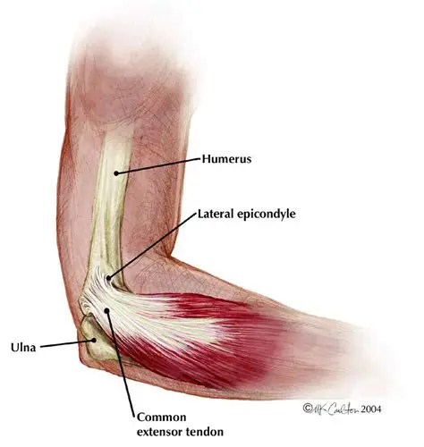<p>The *outer bony bump of the distal humerus origin of wrist and finger extensors*. ⚙️</p>