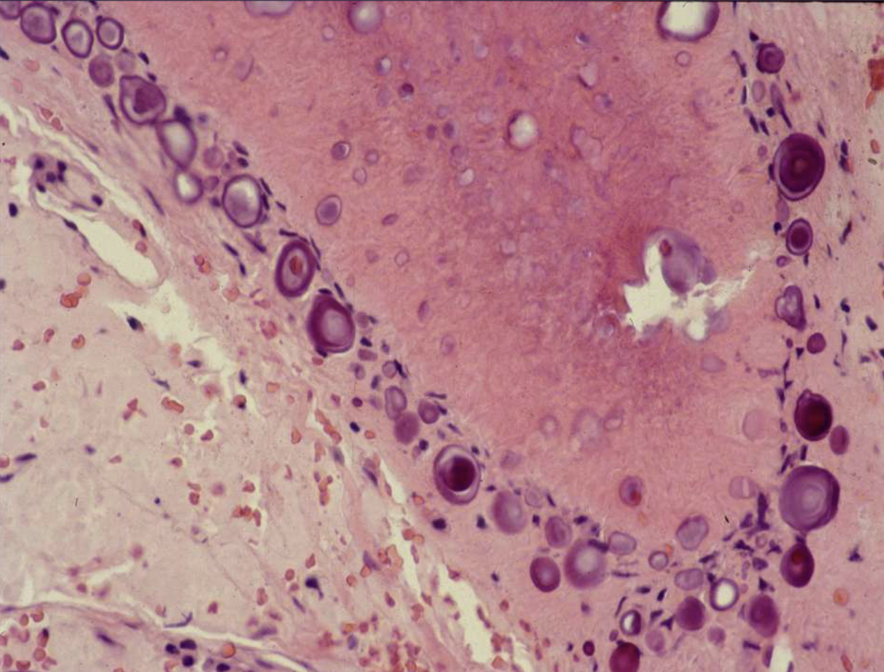 <ol><li><p>islands, strands, or sheets of epithelial cells in fibrous stroma</p></li><li><p>Liesegang rings </p></li></ol><p></p>