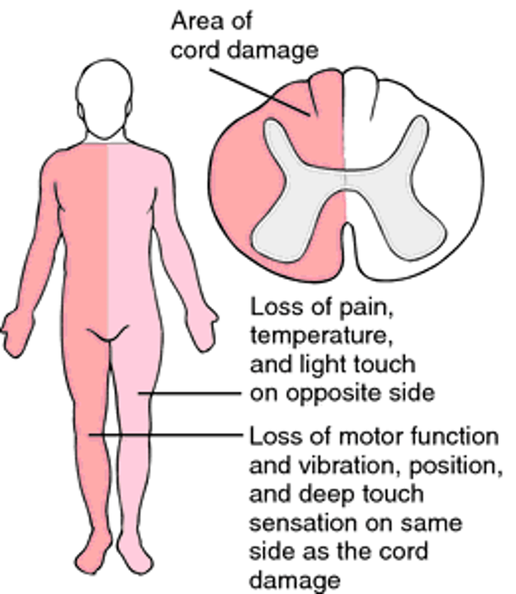<p>Hemi-section of the cord</p><p>ipsilateral (same side) spastic paralysis and loss of position sense</p><p>contralateral (opposite side) loss of pain and thermal sense</p>