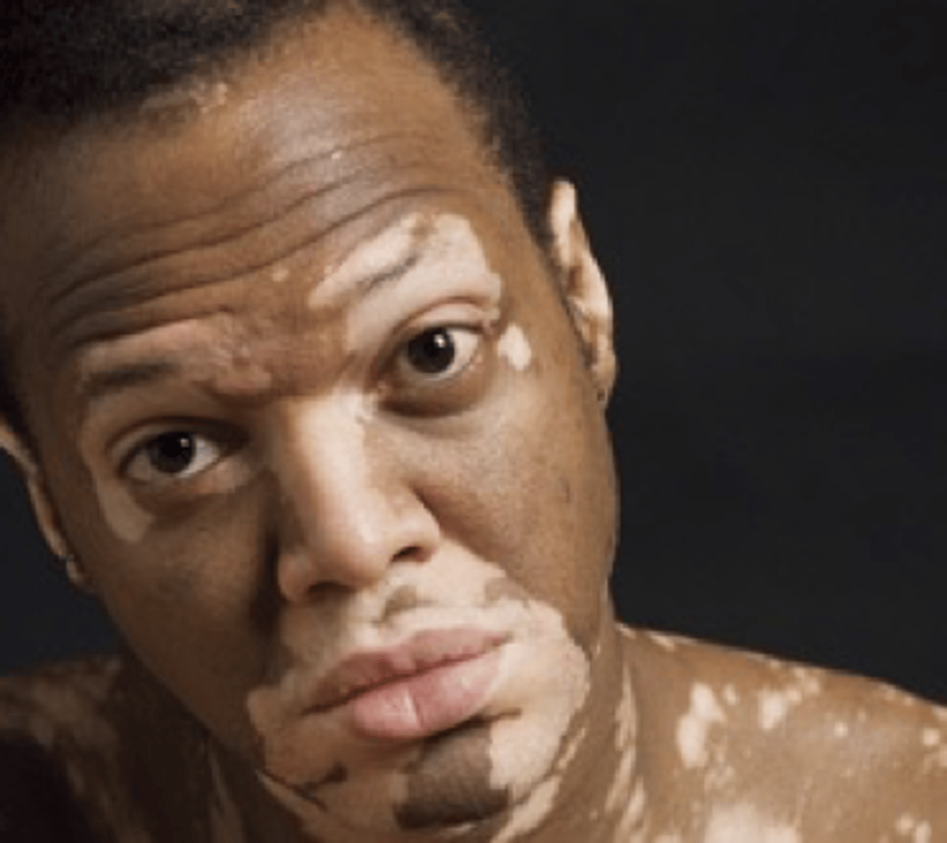 <p>name this skin pathology</p>