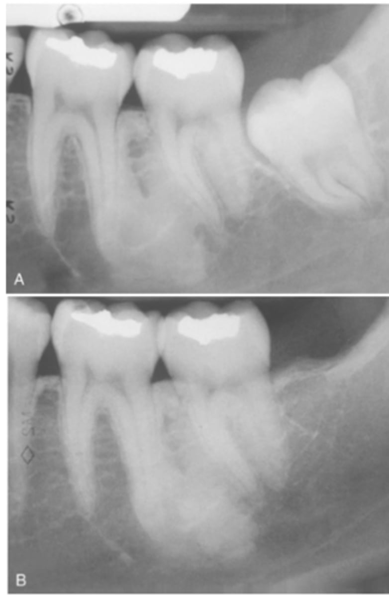 <p>What is Idiopathic Osteosclerosis (dense bone island)</p>