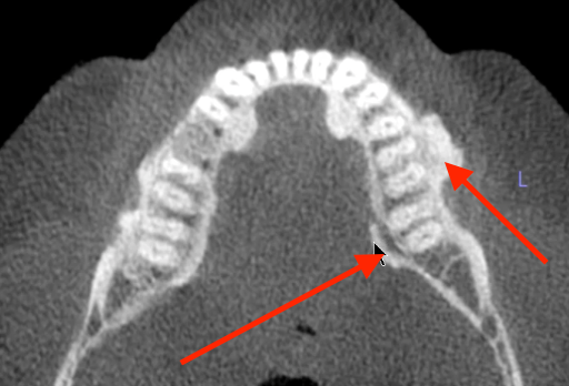 <p>what are these radiopaque lesions?</p>