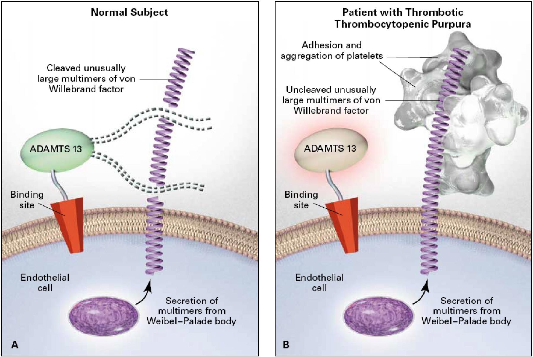 <ul><li><p>↓/inhibited ADAMTS13 → uncleaved ultra-large vWF multimers</p></li><li><p>→ platelet microthrombi in small vessels</p></li><li><p>Acquired: anti-ADAMTS13 autoantibody</p></li><li><p>Congenital: inherited ADAMTS13 deficiency</p></li></ul><p></p>