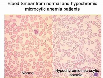 <p>Cause: chronic infections</p><p>-Infections: HIV</p><p>-Inflammatory conditions: rheumatoid arthritis, SLE</p><p>-Diseases: renal failure, congestive heart failure, COPD</p><p>-Malignancies: leukemia, lymphoma</p><p>-microcytic, hypochromic</p>