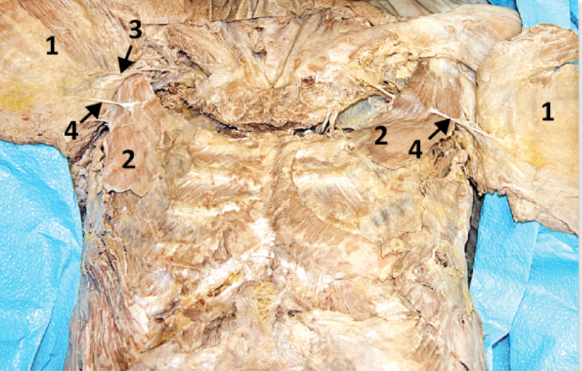 <p>Supplies innervation to pectoralis major and minor (located laterally - pierces into to pectoralis minor) - Include number in diagram</p>