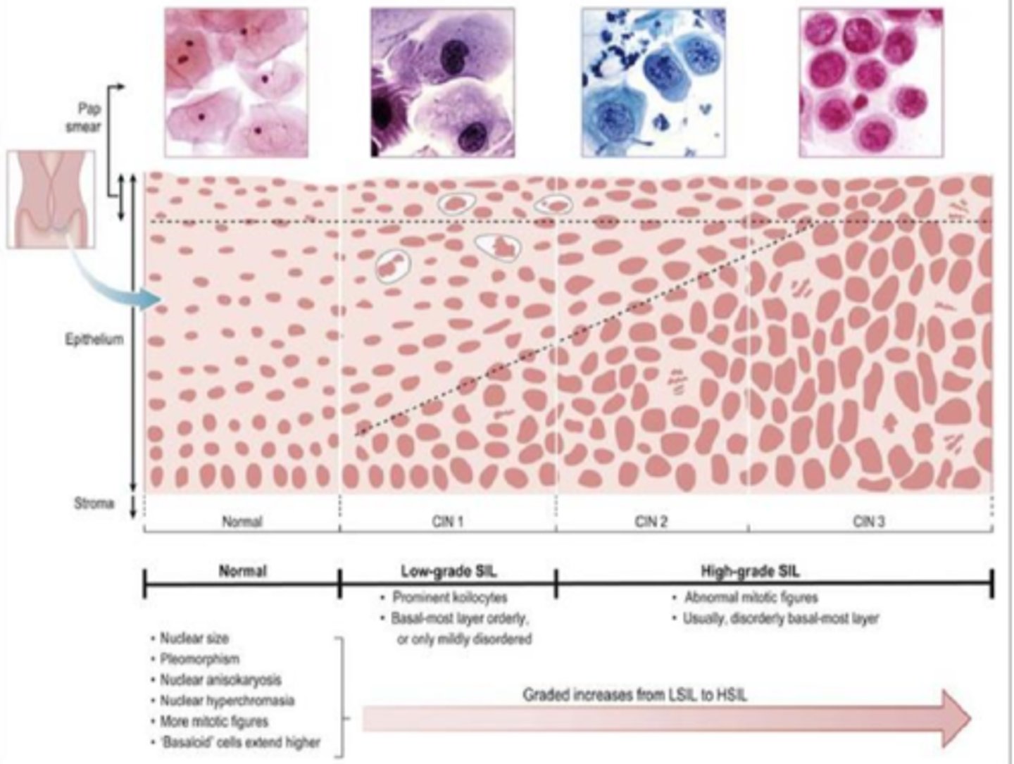 <p>Cervical intraepithelial neoplasia (CIN)</p><p>Cervical glandular intraepithelial neoplasia (CGIN)</p>