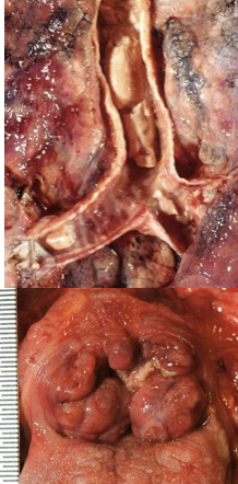 <p><span>suffocation due to obstruction of airway; no petechiae</span></p>