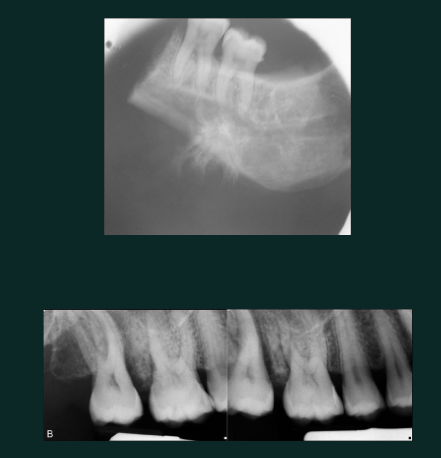 <p>Mixed</p><p>sunburst RO</p><p>widening PDL space without trauma</p><p>irregular destructive bone changes</p><p>pain and swelling clinically</p><p>malignant&nbsp;</p>