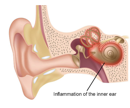 <p>Caused by:</p><ul><li><p>Inflammation of the <strong><u>entire inner ear</u></strong> due to infection</p></li></ul><p>Symptoms:</p><ul><li><p>Sudden vertigo that can last for several days</p></li><li><p><u>Does</u> affect hearing</p></li></ul><p>Treatment:</p><ul><li><p>Treat infection</p></li><li><p>Anti-nausea medication until inflammation reduces</p></li><li><p>Physical therapy/activity can help the body compensate</p></li></ul><p></p>