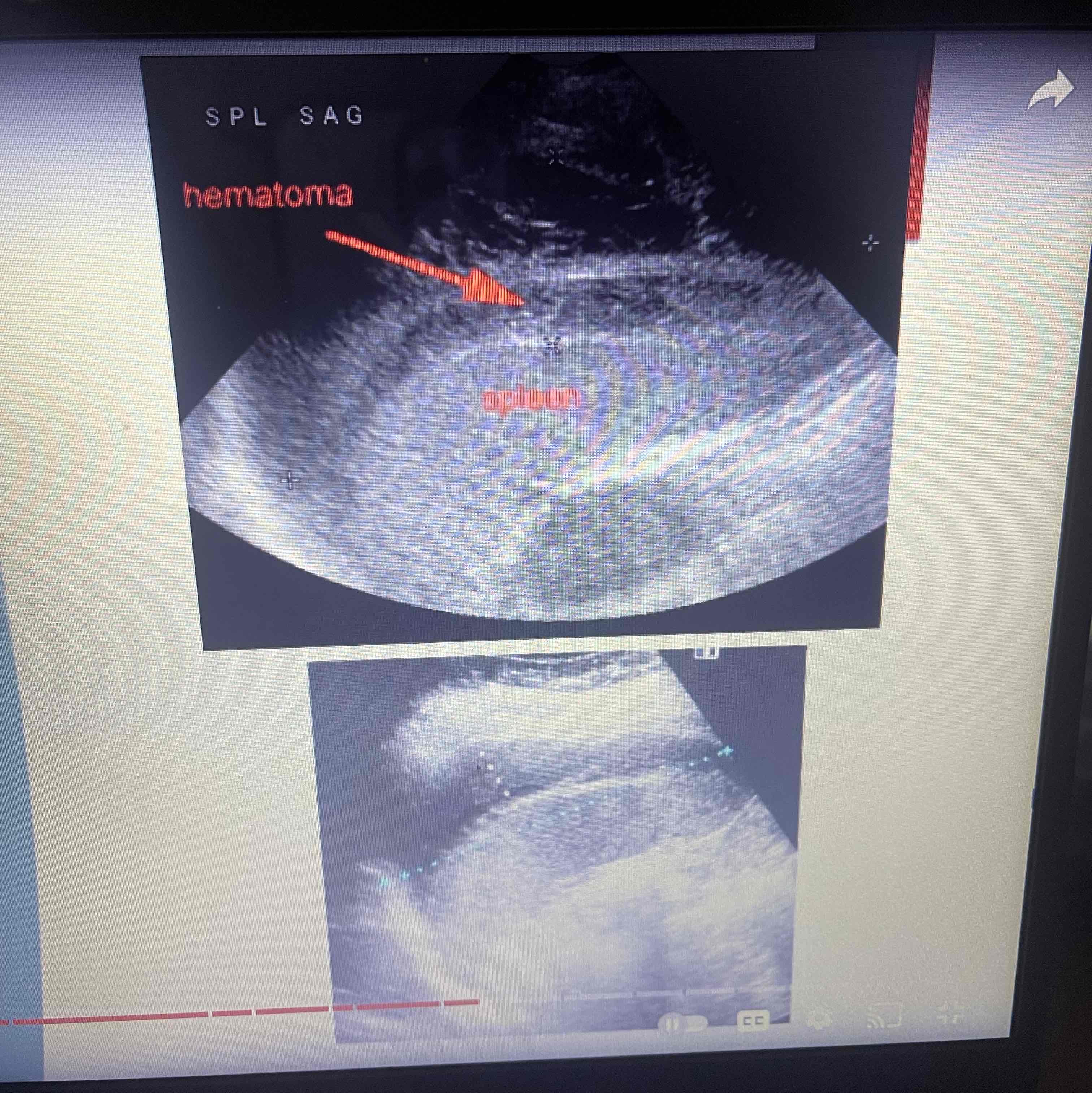 <ul><li><p>Blood abdominal force; MC injury</p></li><li><p>FAST exam : Focused assessment with sonography for drama. Check 4 quads, Morrisons pouch, subdiaphragm, liver and splenic capsules, bladder and rectal regions</p></li><li><p>Clinically: Decreased hematocrit, Shock</p></li><li><p>Sonographic: eval for eternal hemorrhage, eval for FF</p></li></ul>