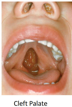 <p>A congenital fissure in the midline of the palate.The palatine process of the maxillae and palatine bones don’t fuse completely orat all. </p>