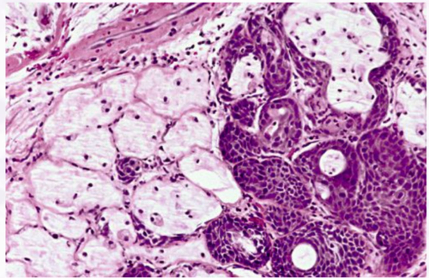 <p>Pseudoepitheliomatous hyperplasia, Coagulative necrosis of</p><p>the adjacent glands</p>