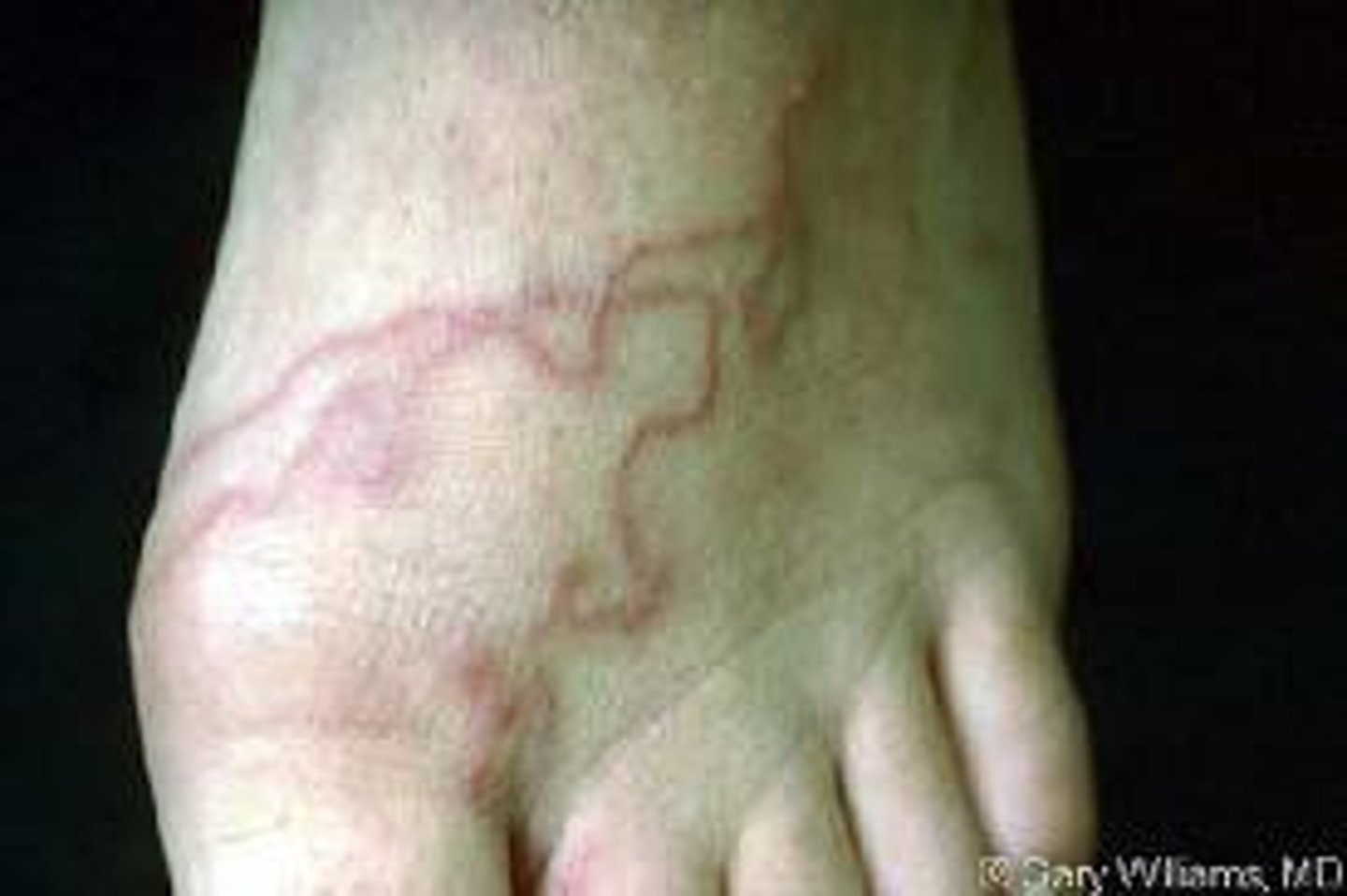 <p>Serpiginous</p>