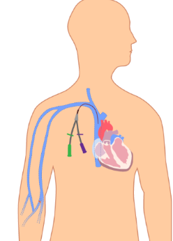<p>which catheter type does this image show (be specific)</p>