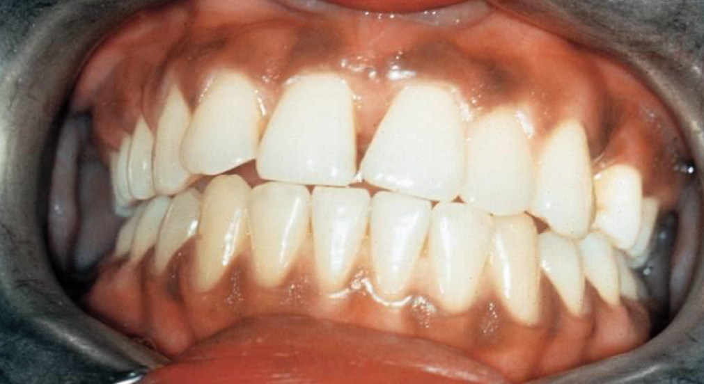 <p>Melanin Pigmentation </p>