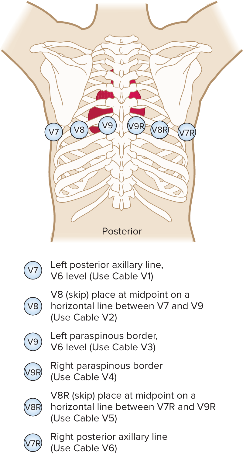 <p>Known as a posterior 12-lead ECG focuses on the posterior aspect of the heart. </p>