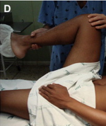 <p>is a clinical sign of acute appendicitis, it is defined as&nbsp;<strong>discomfort felt by the subject/patient on the slow flexion &amp; internal rotation of the hip joint, while the right knee is flexed</strong>. It indicates an inflamed pelvic appendix that is in contact with the obturator internus muscle</p>