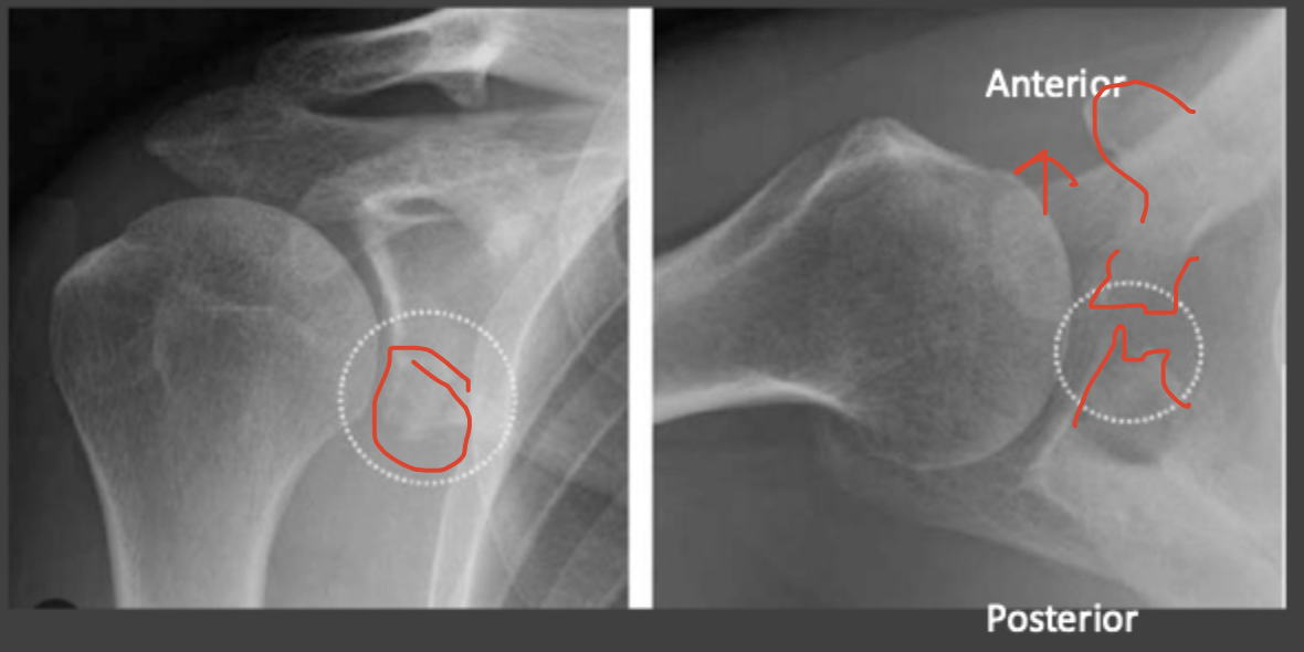 <p>An injury of the anterior (inferior) glenoid labrum associated with shoulder dislocations - surgery indication (glenoid labrum is disrupted)</p>