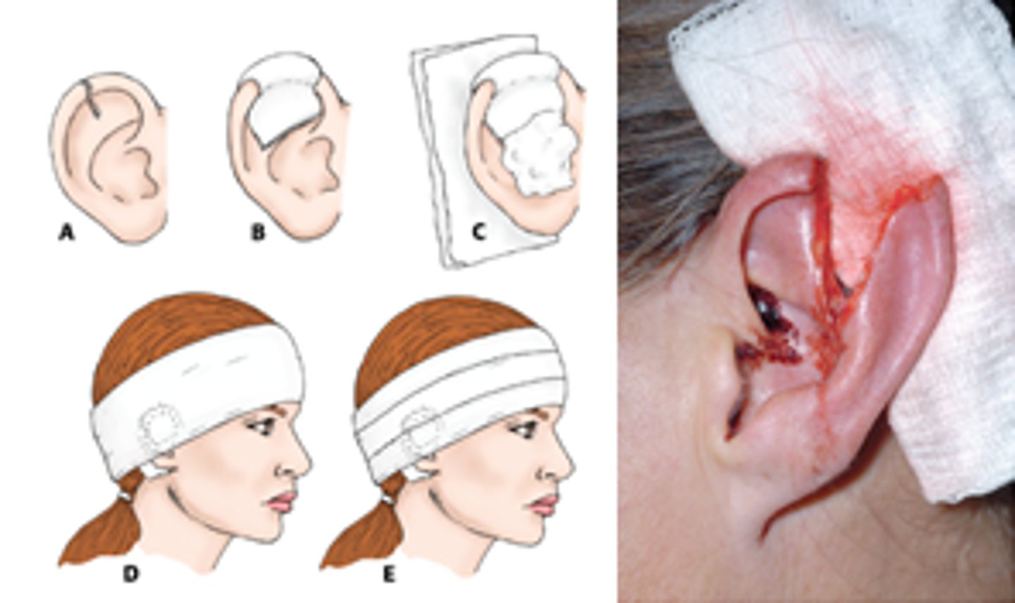 <p>Use 5.0-6.0 vicryl and approximate using cartilage rings of pinnae</p><p>pad the ear extensively and wrap head after to distribute pressure evenly so there is minimal risk of hematoma/ necrosis</p>