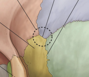 <ul><li><p>coronal suture: joins frontal bone to sphenoid and parietal bones</p></li><li><p>sphenosquamous suture: joins sphenoid and temporal bones</p></li><li><p>squamous suture: joins temporal bone to sphenoid and parietal bones</p></li><li><p>sphenoparietal suture: joins sphenoid and parietal bones</p></li><li><p>sphenofrontal suture: joins sphenoid and frontal bones </p></li></ul><p></p>