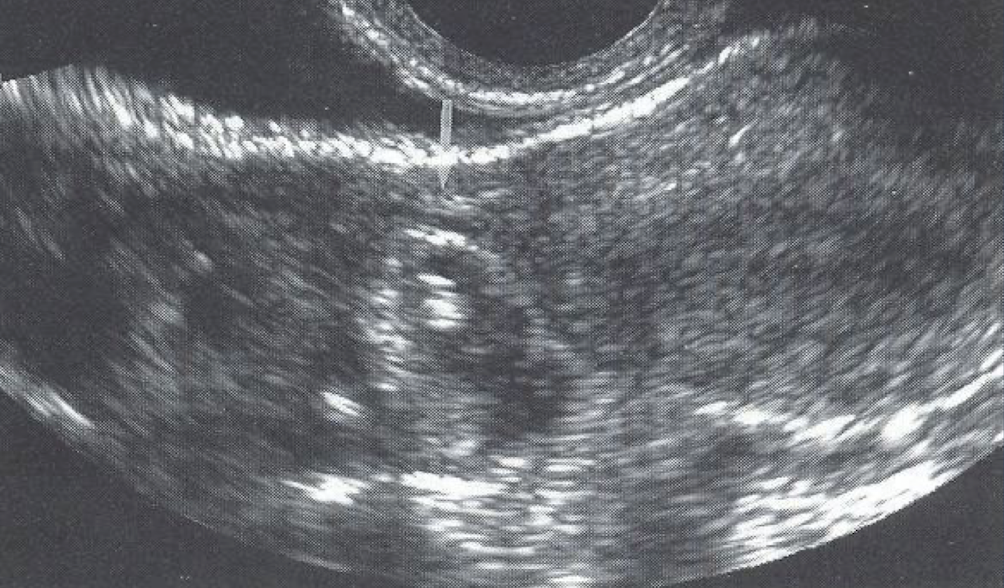 <p>usually not seen unless significantly distended (from fluid, pus, blood)</p><p></p>