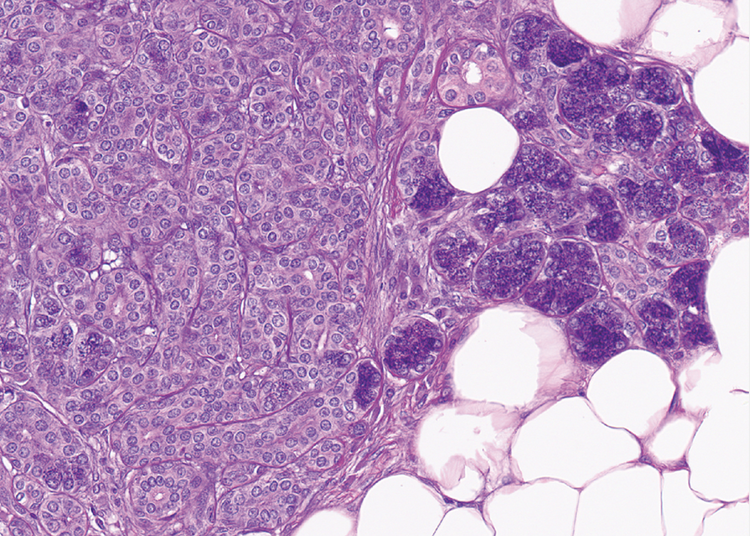 <p>Femme de 50 ans avec biopsie parotide (pas de masse) </p><p>1) Diagnostic. </p><p>2) Epidemiologie (age, localisation, agressivité) </p><p>3) Histologie</p><p>4) IHC</p><p>5) Moléculaire </p><p>6) DD</p>