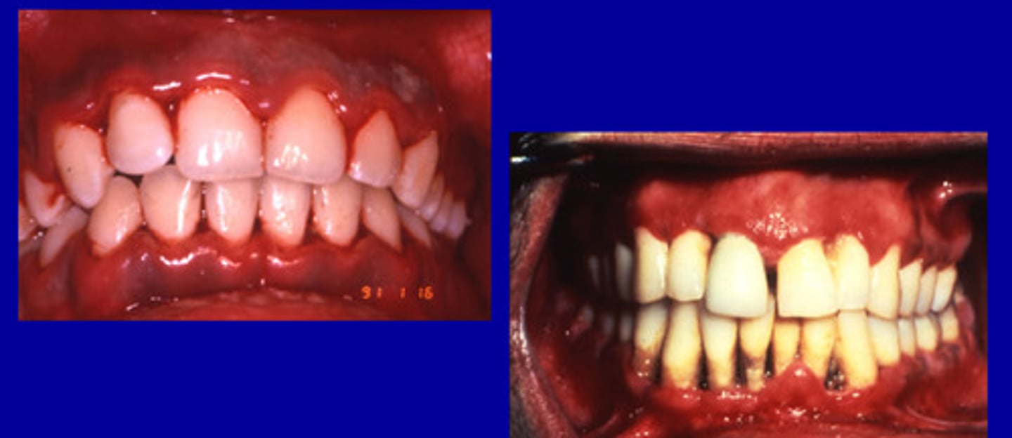 <p>painful infections characterized by tissue ulceration, swelling and sloughing of dead epithelial tissue from the gingiva, and fetid oral odor</p>