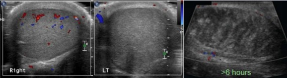 <ol><li><p>What is different about the right and left testicles?</p></li><li><p>What can be interpreted of the image on the far right?</p></li><li><p>What pathology can be assumed happening in these pictures?</p></li></ol><p></p>
