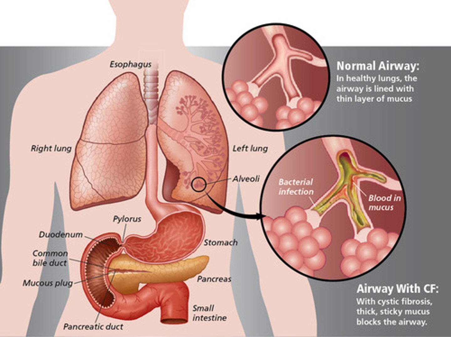 <p>DF508 mutation of the CF transmembrane R (CFTR)</p><p>- CFTR is a Cl- channel on the apical surface of epithelial cells lining the lung airways</p><p>- CFTR DF508 misfolds in the ER</p><p>- leads to a buildup of IC Cl- ions</p>